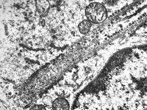 M,41y. | hairy cell leukemia - spleen - ribosome-lamella complex in tricholeukocyte M,41y. | hairy cell leukemia - spleen - ribosome-lamella complex in tricholeukocyte
